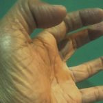 Dokter UGM Jelaskan Penyebab Epilepsi, Ini Pertolongan yang Bisa Dilakukan