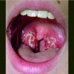 Sedang Sakit Amandel? Jangan Cemas, Simak Penjelasan Dokter Hesti dari UGM